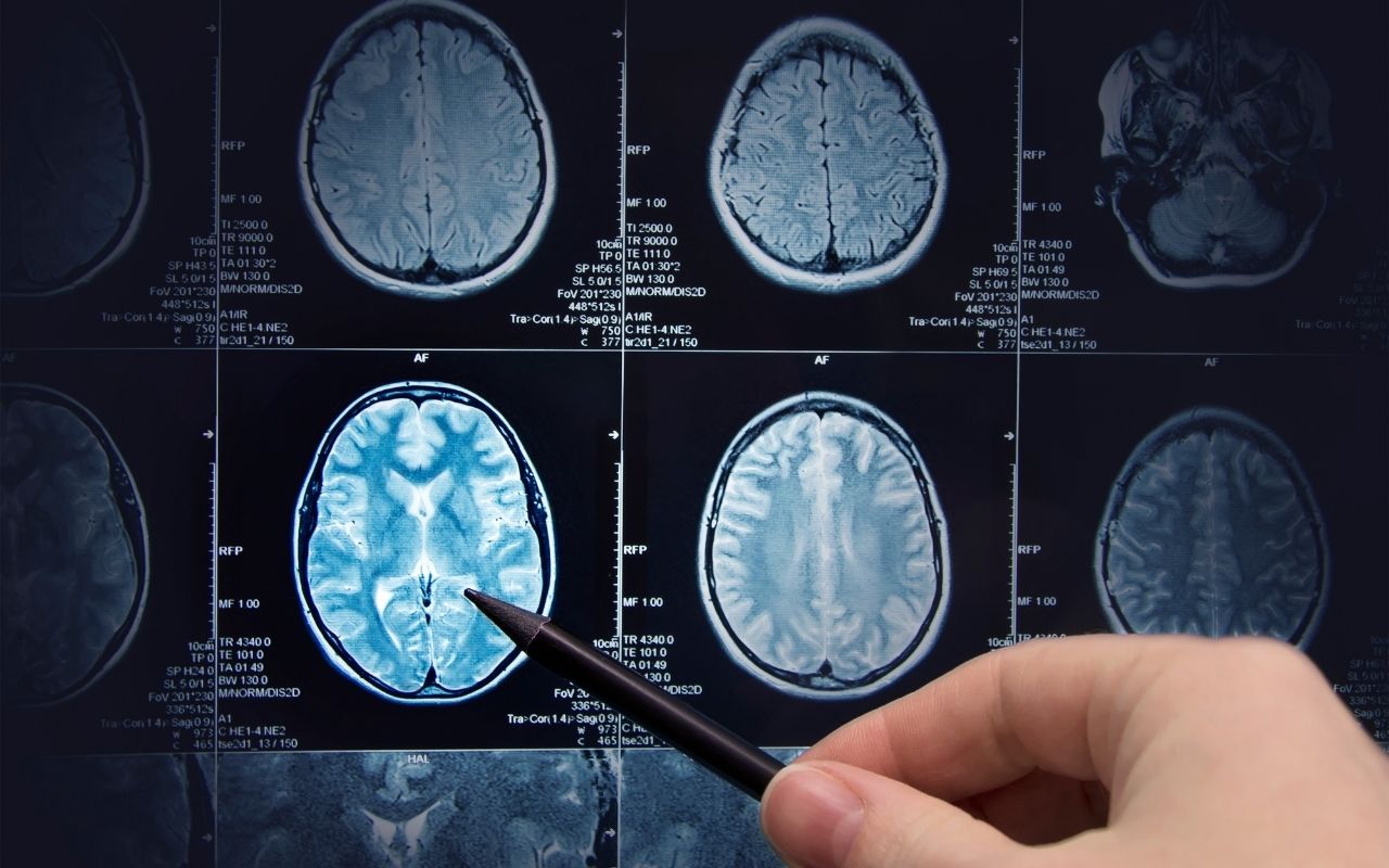 Những điều cần biết về phương pháp chụp MRI não