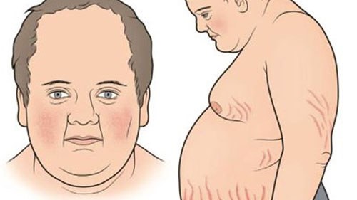 Những điều cần biết về hội chứng Cushing
