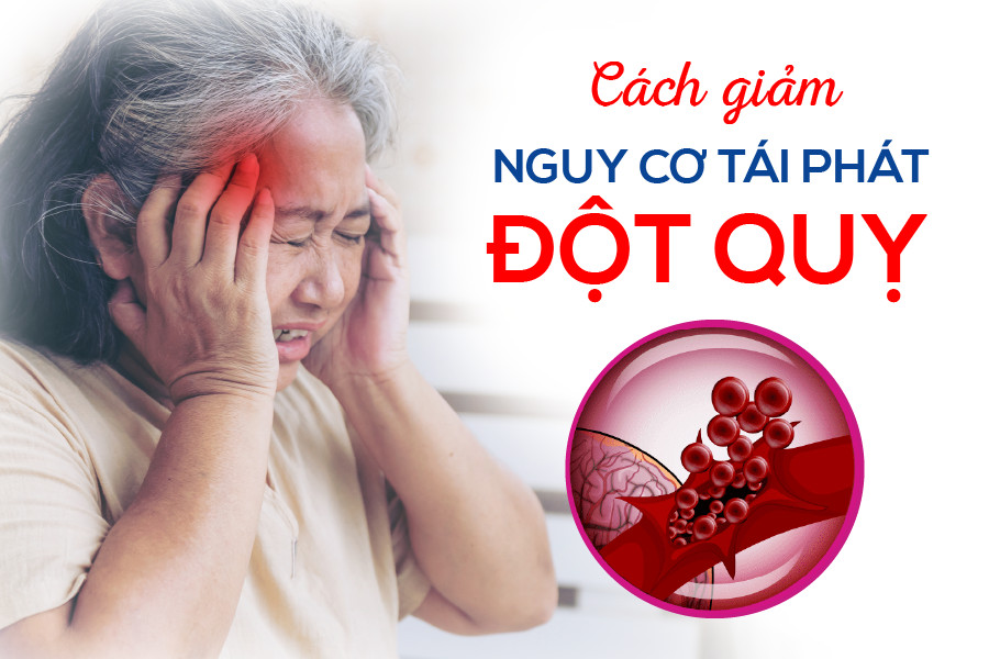 Nguy cơ đột quỵ tái phát giảm 16% nếu kiểm soát tốt yếu tố này