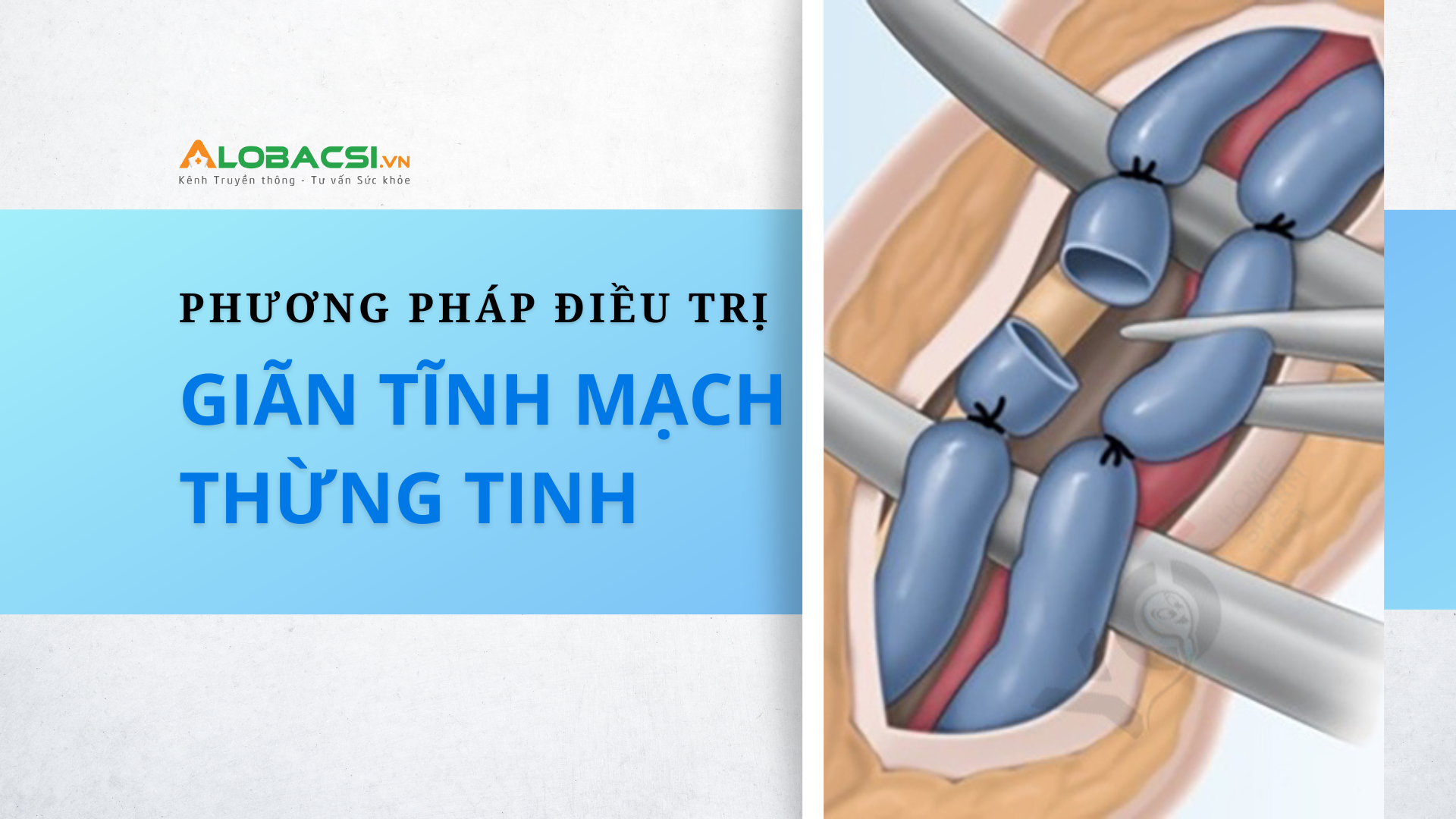 40% nam giới vô sinh, hiếm muộn có thể có con tự nhiên sau khi cột tĩnh mạch tinh vi phẫu