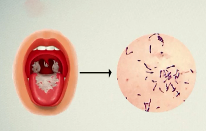 Bác sĩ hướng dẫn cách phòng tránh lây nhiễm bệnh bạch hầu