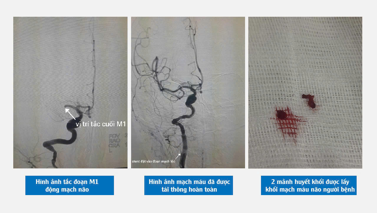 Đang đun bếp, phụ nữ 49 tuổi bất ngờ bị đột quỵ