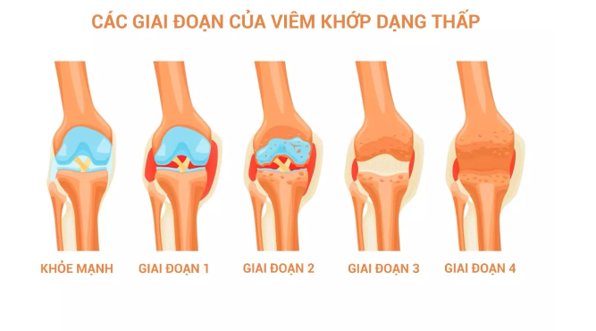 Chẩn đoán và phòng ngừa viêm khớp dạng thấp như thế nào?
