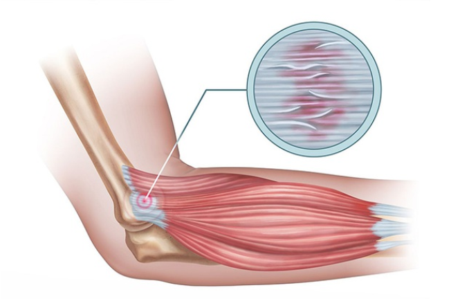 Những điều cần biết về viêm điểm bám gân lồi cầu ngoài xương cánh tay