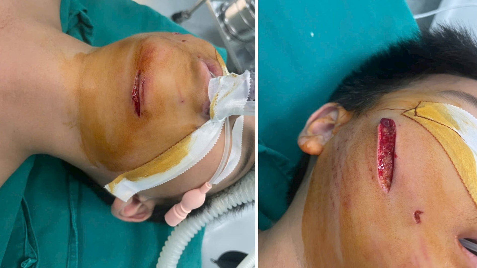 Thanh Hóa: Bé trai 9 tuổi bị chó nhà cắn rách mặt