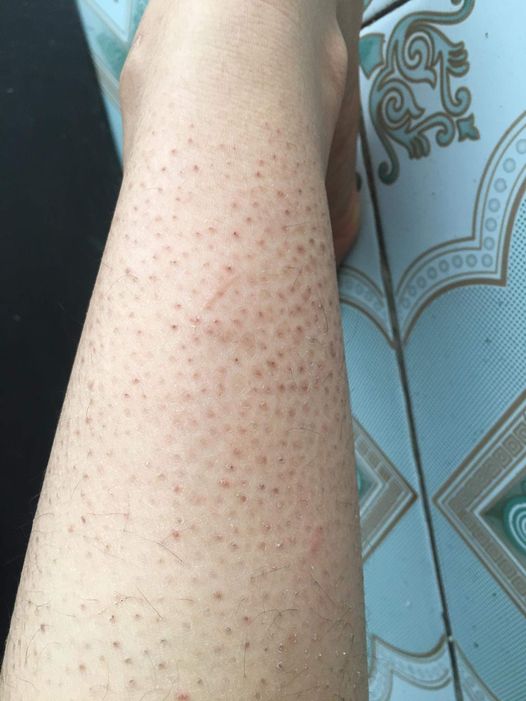 Bài thuốc trị viêm nang lông từ Bảo Thanh Đường