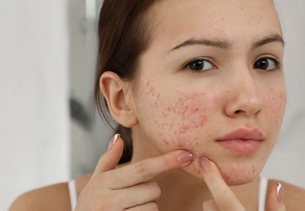 Giải pháp tạm biệt mụn trứng cá tuổi dậy thì