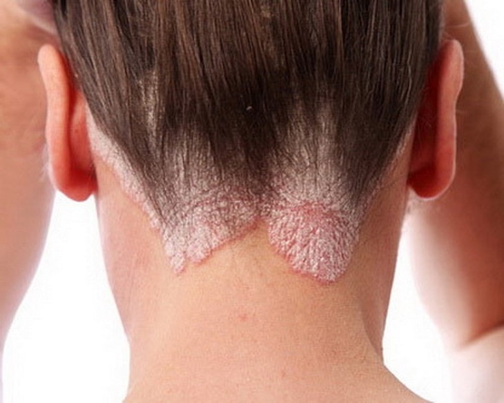 Khỏi á sừng da đầu nhờ bài thuốc bằng thảo dược thiên nhiên