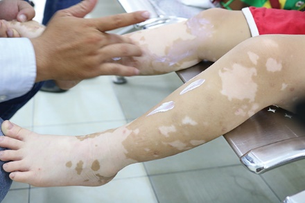 Địa chỉ chữa bệnh Bạch biến cho trẻ tuổi dậy thì uy tín ở đâu