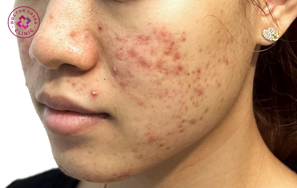 Cách trị mụn tuổi dậy thì chuẩn y khoa