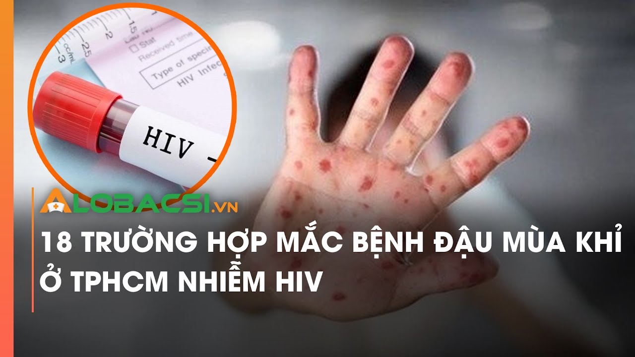 18 trường hợp mắc bệnh đậu mùa khỉ ở TPHCM nhiễm HIV