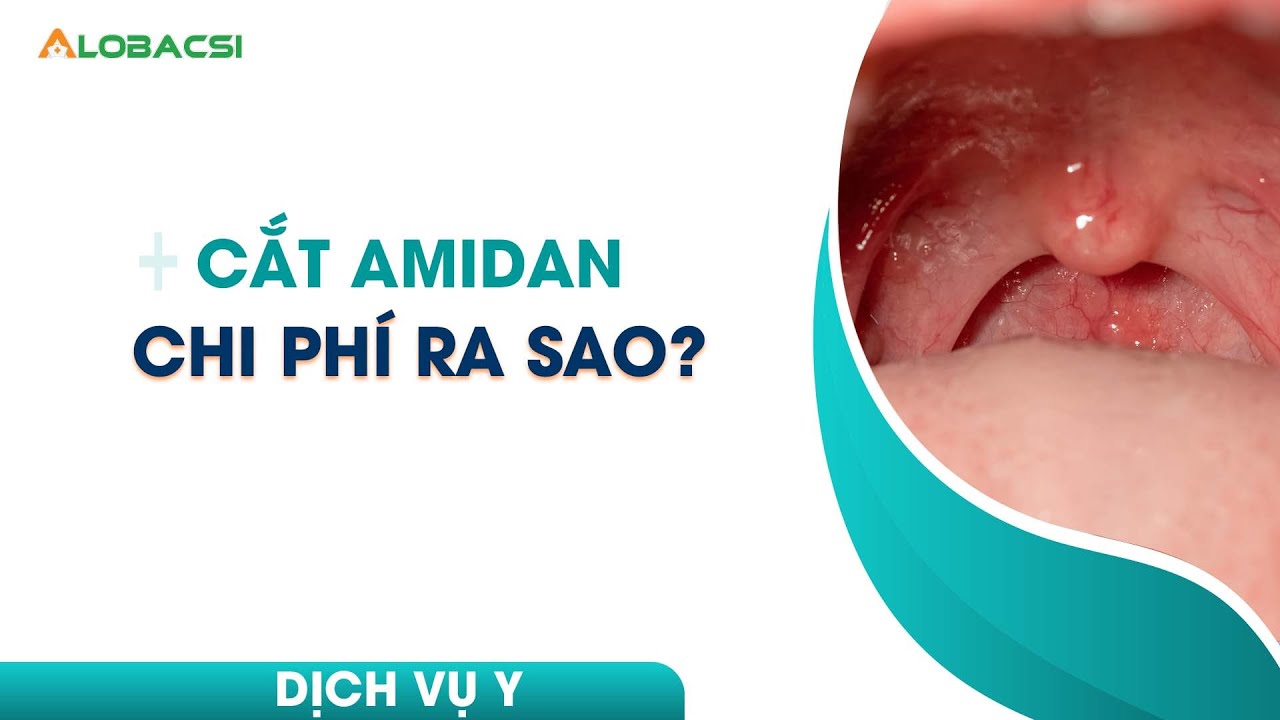 Cắt amidan chi phí ra sao?