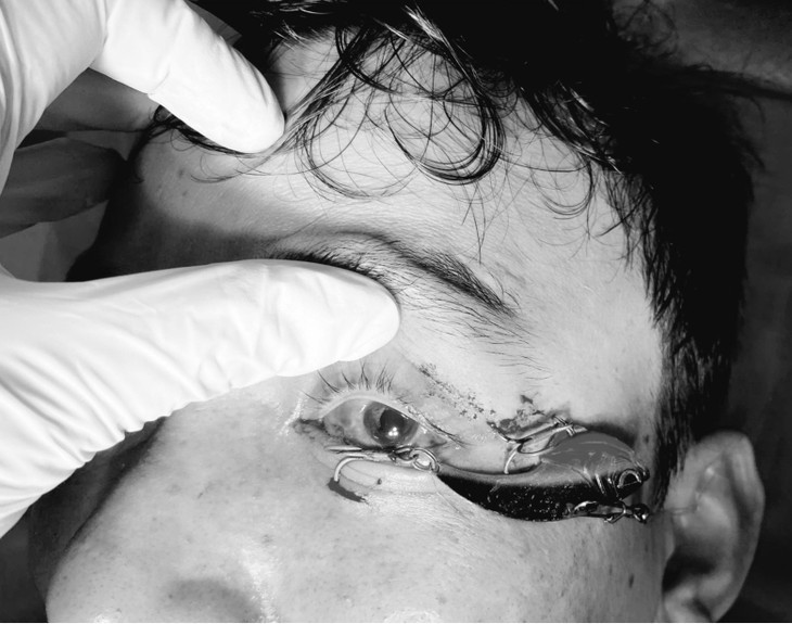 Lưỡi câu móc vào mắt khi đi câu cá