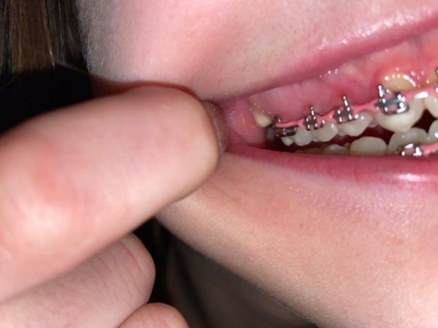 Nước súc miệng Waterine Ortho có thật sự tốt cho người niềng răng?