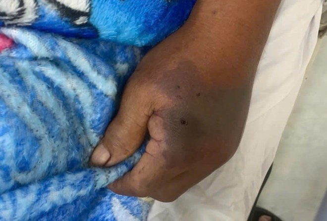 Ra thăm vườn, cụ ông bị rắn hổ đất cắn phải tiêm 18 lọ huyết thanh