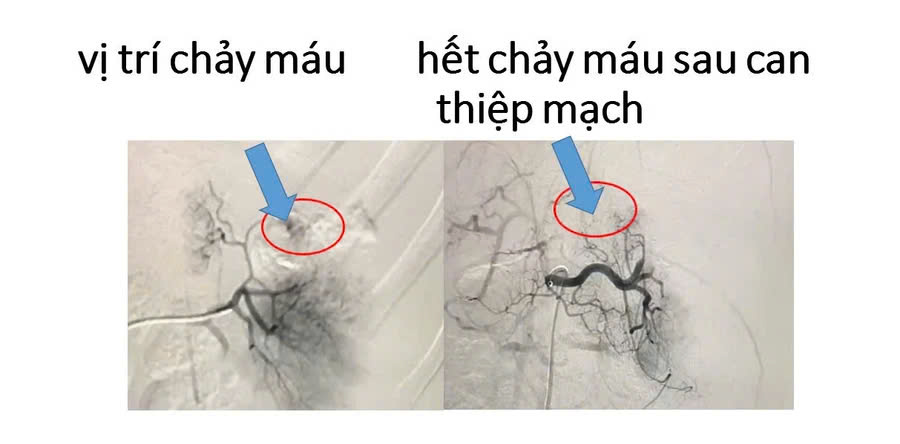 Ngồi trước xe máy, bé gái 5 tuổi bị vỡ lách khi gặp tai nạn giao thông