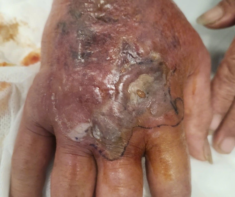 Sau bão Yagi, Bệnh viện Bạch Mai tiếp nhận nhiều trường hợp nhập viện do rắn độc cắn