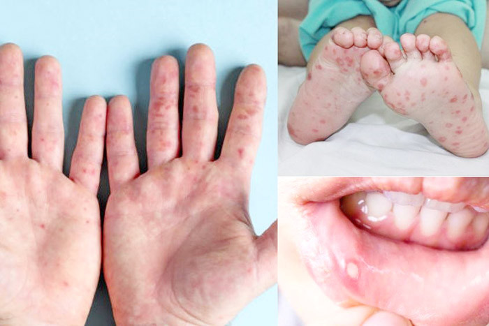 Bệnh nhi 3 tuổi mắc tay chân miệng tử vong sau 15 phút nhập viện