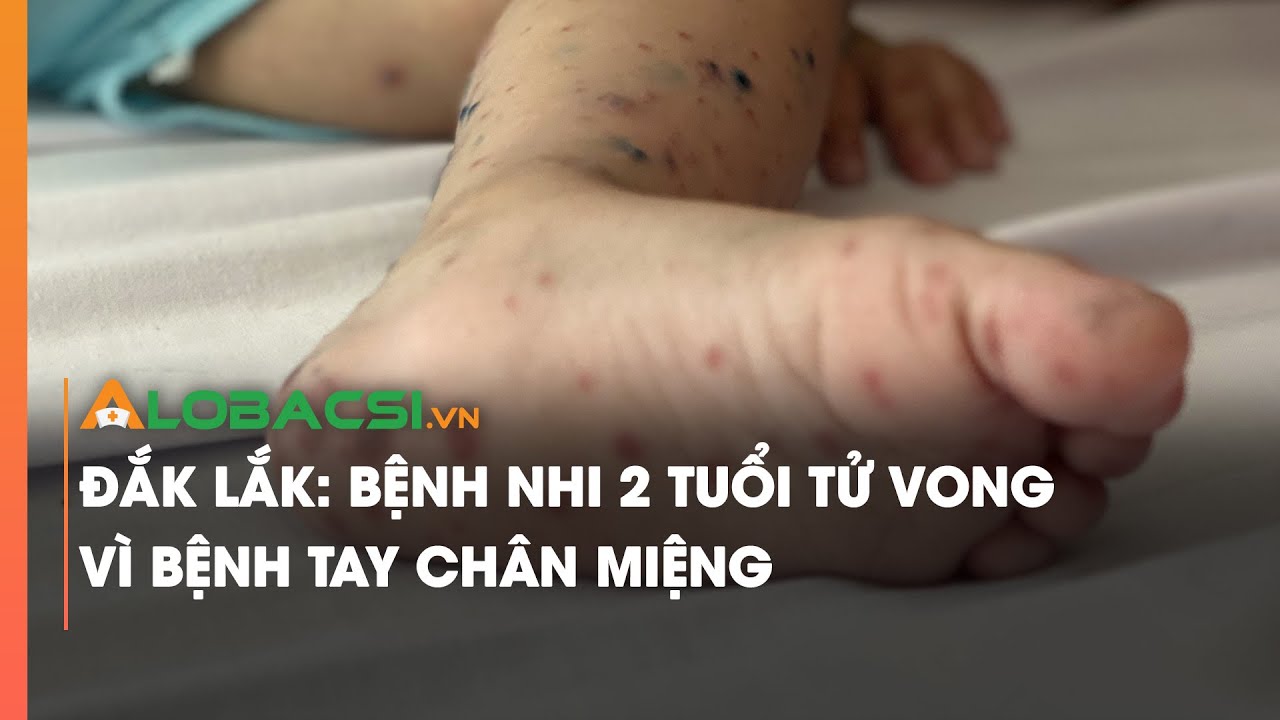 Đắk Lắk: Bệnh nhi 2 tuổi tử vong vì bệnh tay chân miệng